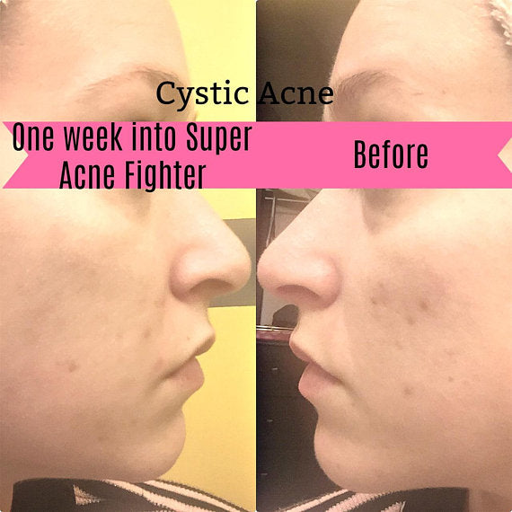 Super Acne Fighter / Organic Acne Treatment / Acne